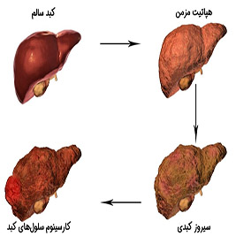 سیروز کبدی یا تنبلی کبد