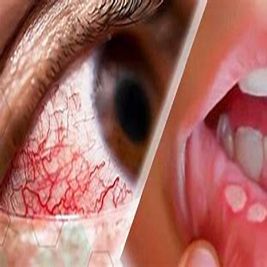 بیماری بهجت یا بیماری چیچک 